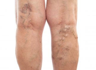 Picioarele umflate ar putea fi semnul unei probleme de sanatate mai grave