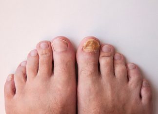 Distrugator natural pentru ciupercile unghiilor